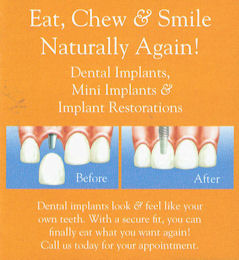 benefits of dental implants.